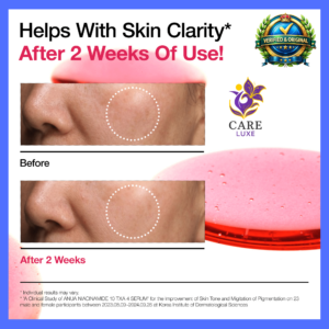 Before and after results using Anua Niacinamide 10 + TXA 4 dark spot serum